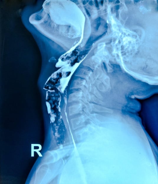 An MRI scan image highlighting the improved spinal disc hydration and reduced inflammation in a patient who has been practicing yoga regularly for back pain, compared to a baseline scan.