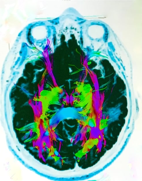 A brain scan image showing heightened activity in stress-related areas (amygdala, hypothalamus) in individuals who are sleep-deprived, compared to those with adequate sleep.