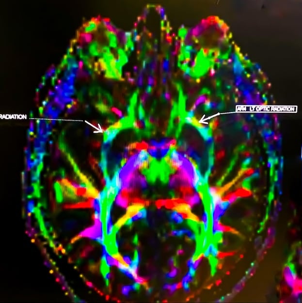 A close-up photo of brain scans highlighting areas related to creativity and focus. The scans show increased activity in the prefrontal cortex and other regions associated with innovative thinking and problem-solving.
